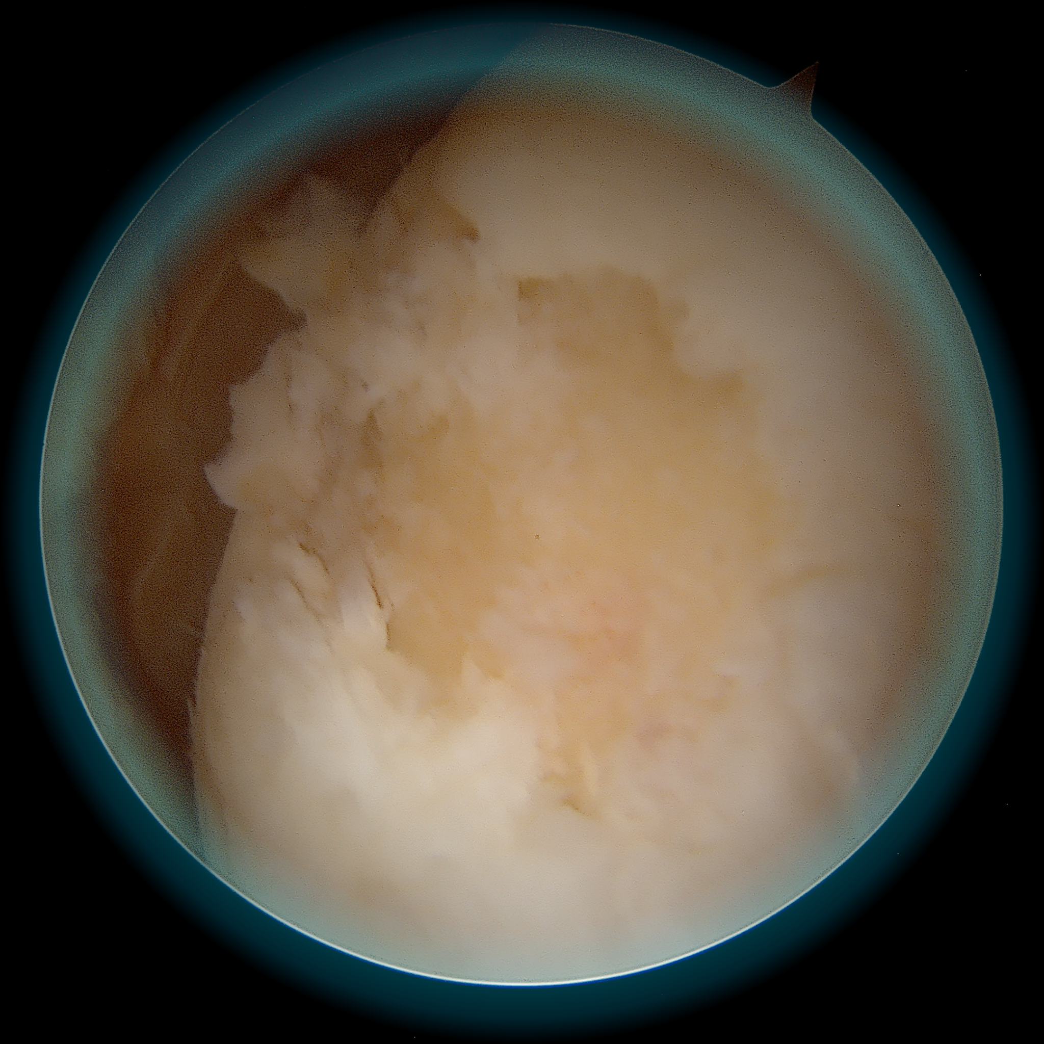 Vue arthroscopique · lésion cartilagineuse